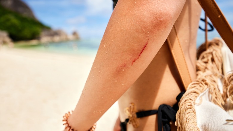 Een vrouw op het strand met een bloederige snee op haar arm